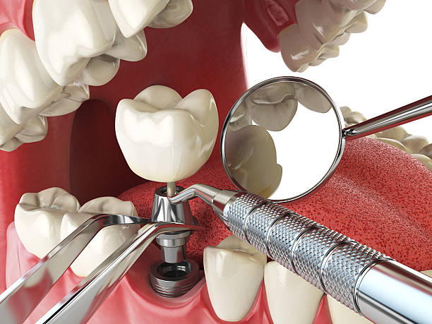 Best Emergency Tooth Extraction in St Paris, OH